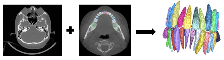 Metal artifact CBCT teeth segmentation